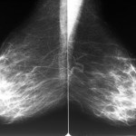 Mammogram